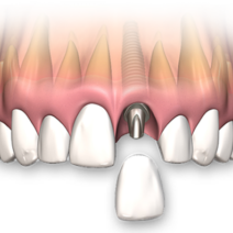 image of a single-tooth implant, showcasing a natural-looking prosthetic tooth.