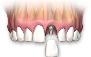 image of a single-tooth implant, showcasing a natural-looking prosthetic tooth.