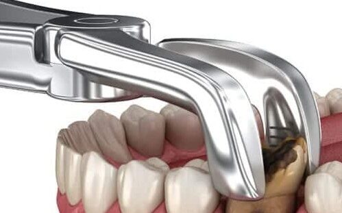 An image illustrating a painless tooth extraction procedure, emphasizing patient comfort.