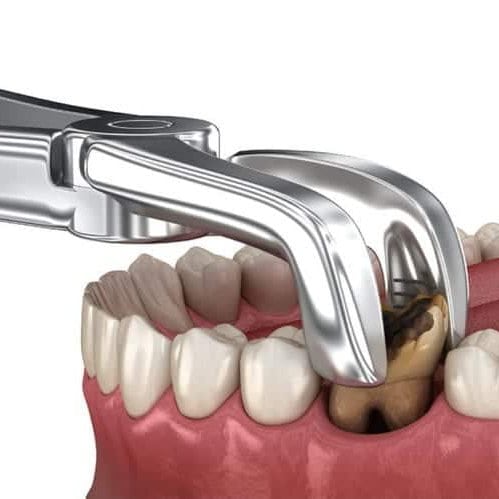 An image illustrating a painless tooth extraction procedure, emphasizing patient comfort.