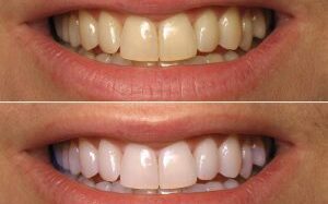 Close-up of teeth showing the results of teeth whitening treatment with a brighter smile.