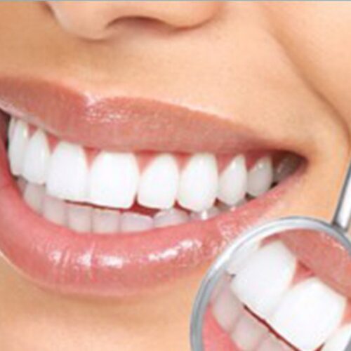 Close-up image of teeth cleaning and polishing, showcasing a bright and polished smile.