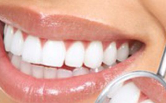 Close-up image of teeth cleaning and polishing, showcasing a bright and polished smile.