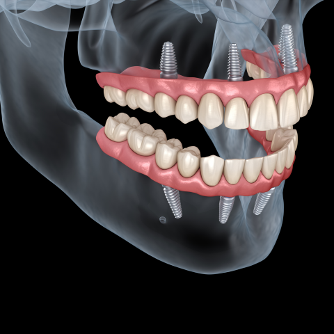 A close-up image of a complete denture, showcasing a natural-looking set of prosthetic teeth on a pink acrylic base.