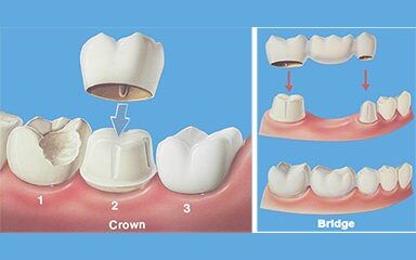 Close-up image of a dental crown and bridge, showcasing restorative dental work.