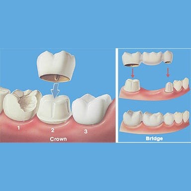 Close-up image of a dental crown and bridge, showcasing restorative dental work.