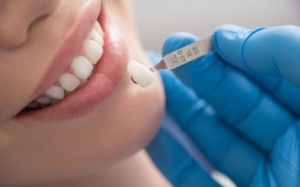 Close-up view of a dental veneer, showcasing a natural-looking and flawless tooth restoration.