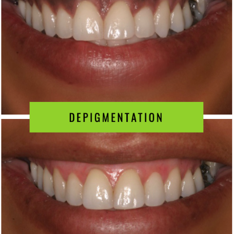 Close-up of a gum depigmentation procedure, highlighting the transformation of darkened gum pigmentation.
