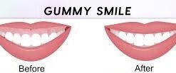 Close-up of a gummy smile treatment, showcasing a transformed and balanced gum-to-tooth ratio.