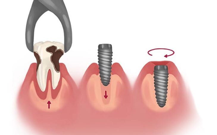 image of an immediate implant, showcasing a seamless integration with surrounding teeth.