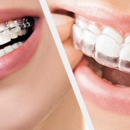 Close-up of orthodontic braces on teeth, highlighting the alignment correction process.