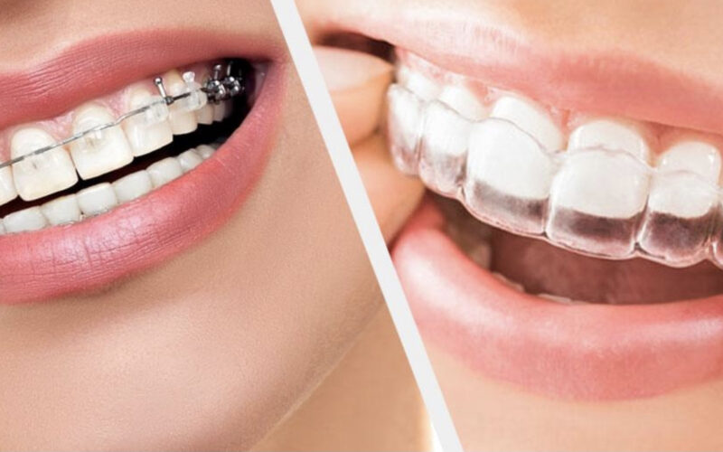 Close-up of orthodontic braces on teeth, highlighting the alignment correction process.