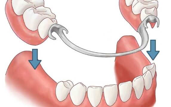 Close-up image of removable partial dentures, highlighting their design for flexibility and ease of use.