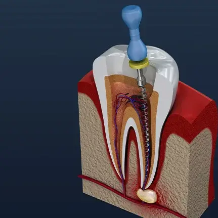Close-up of a root canal procedure, showcasing dental instruments and precision in tooth restoration.