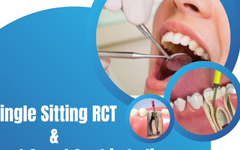 An image illustrating a single-sitting root canal treatment, emphasizing efficiency and patient comfort.