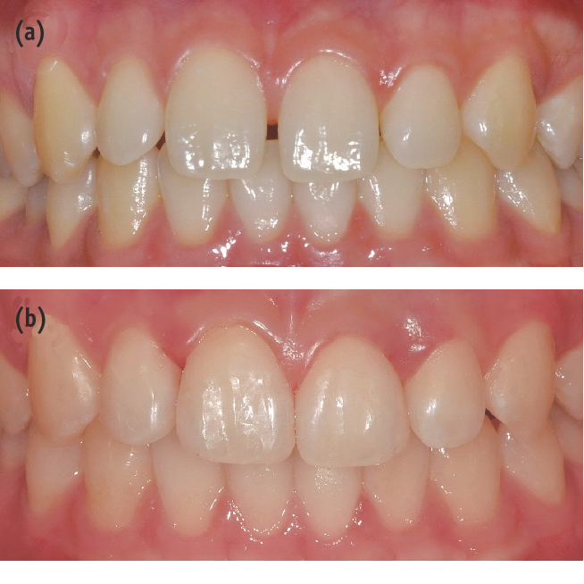 Close-up image illustrating space closure in orthodontic treatment, showcasing teeth alignment.