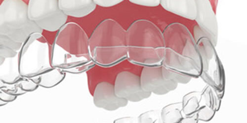 invisalign-clear-aligners-graphic
