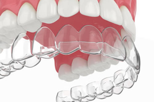 invisalign-clear-aligners-graphic