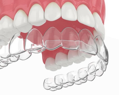 invisalign-clear-aligners-graphic
