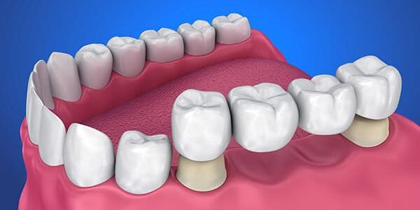 options-for-replacement-multiple-missing-teeth