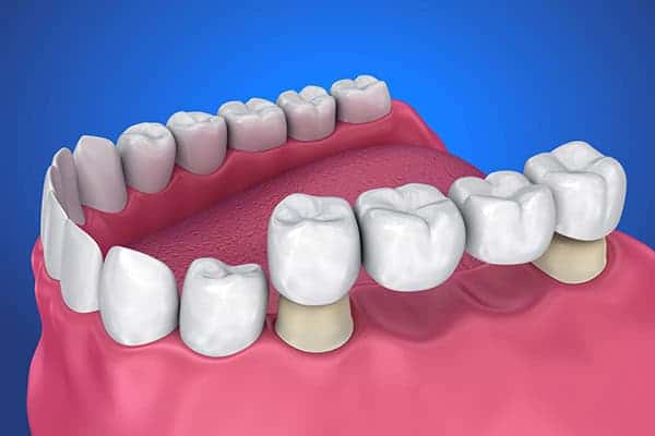 options-for-replacement-multiple-missing-teeth