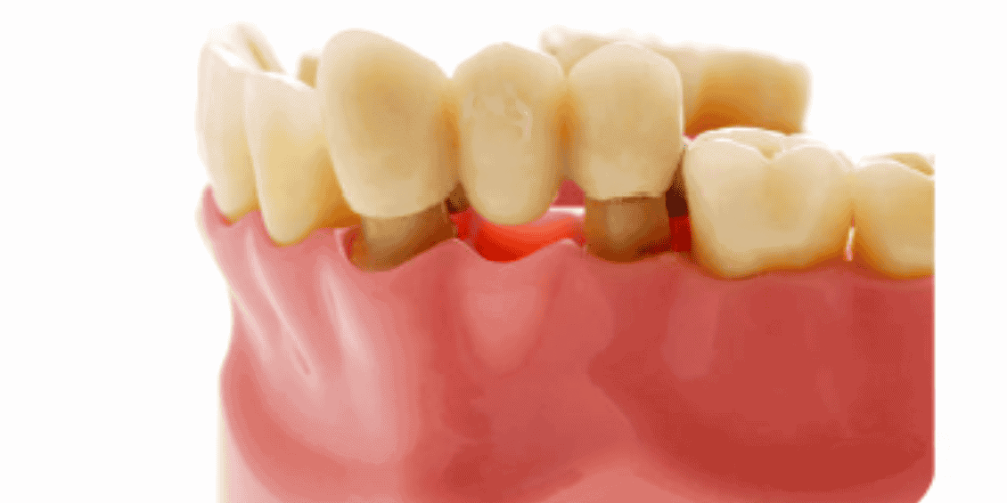 Dental crown