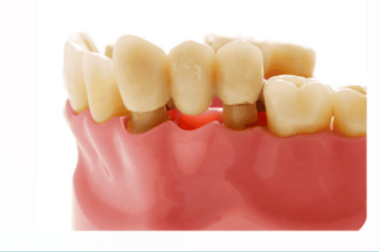 Dental crown