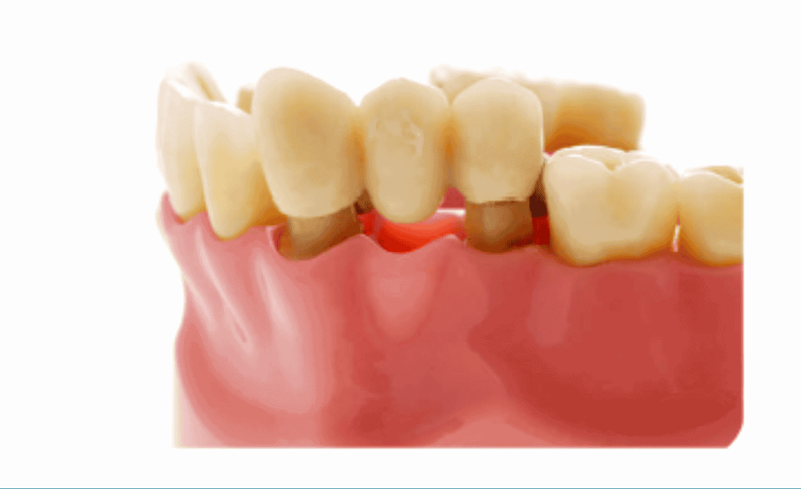Dental crown
