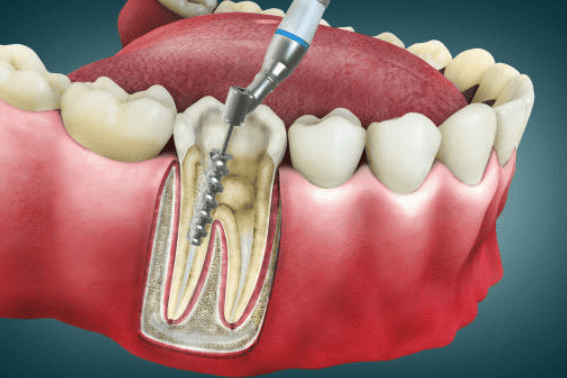 Teeth filling