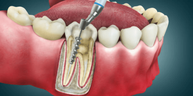 Teeth filling