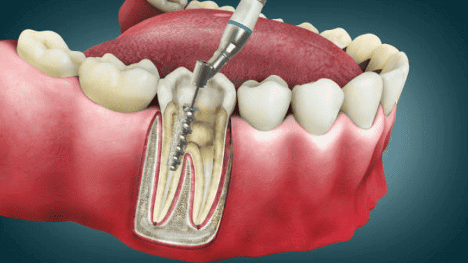 Teeth filling