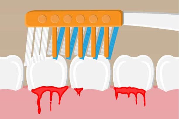 bleeding-gum