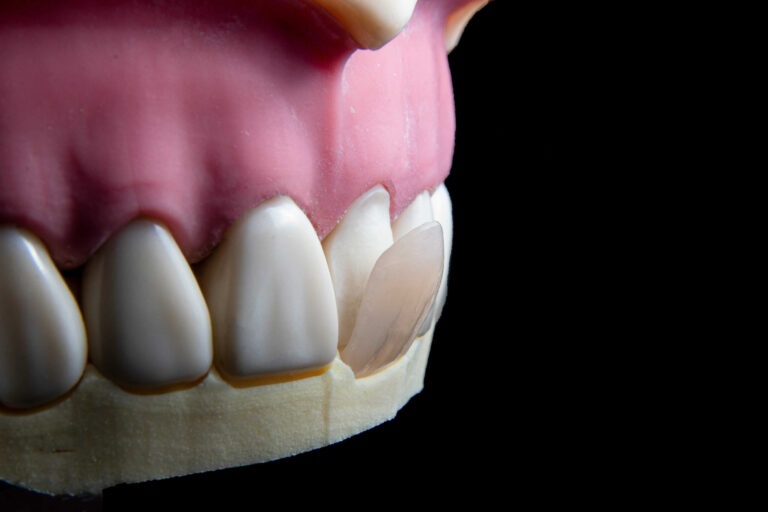 chipped teeth