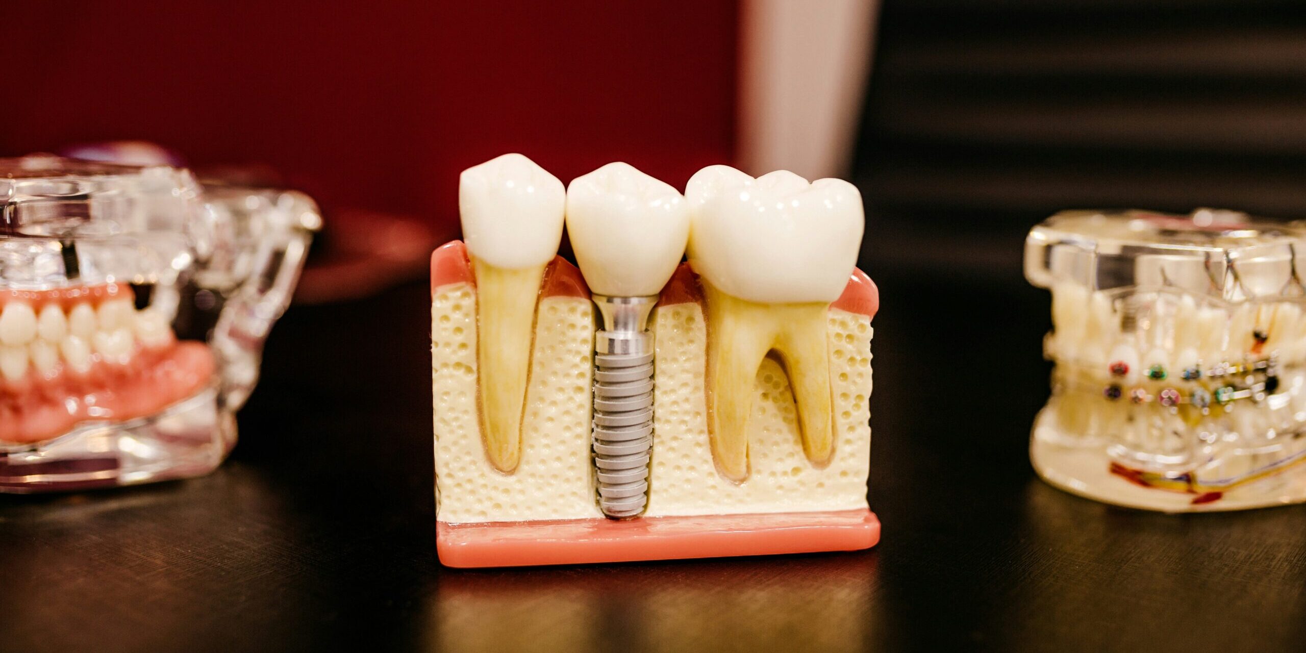 dental Implant