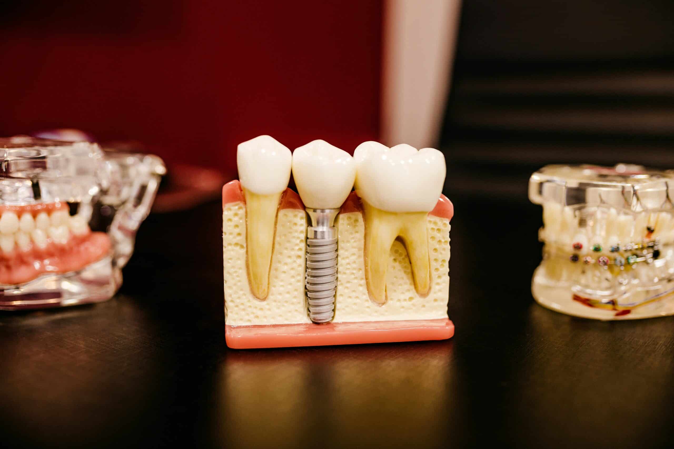 dental Implant